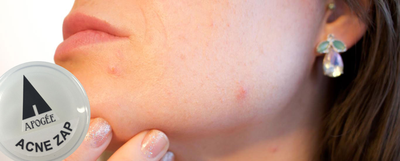 Acne Zap